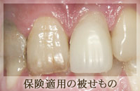 セラミック冠