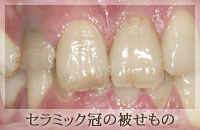 セラミック冠