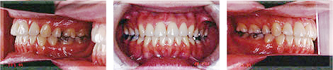 矯正歯科 Case3