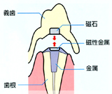 磁性アタッチメント義歯