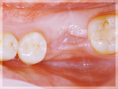 臼歯のインプラント治療