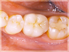 臼歯のインプラント治療