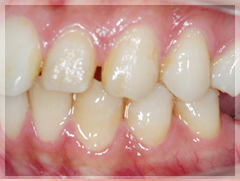 臼歯のインプラント治療