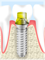 インプラント治療のしくみ