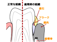 歯周病の原因