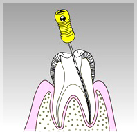 根管治療とは