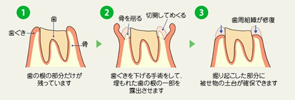 では、フェルールがない場合どのようにフェルールの改善をするのでしょう？