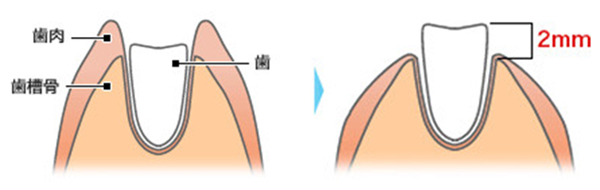 歯茎より2mm上に歯質が必要1