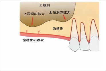 サイナスリフト