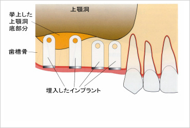 サイナスリフト