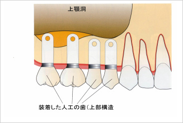 サイナスリフト